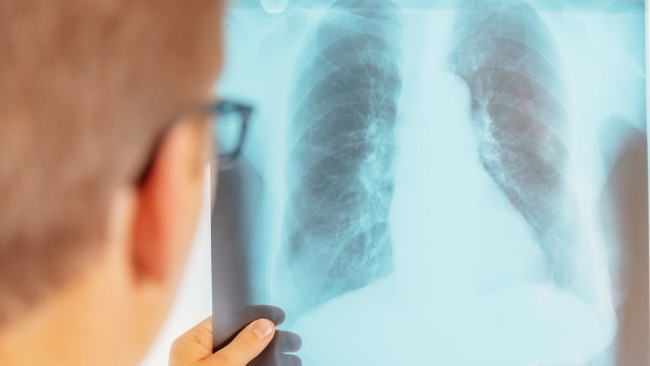 tlmd_tuberculosis_lynn_shutterstock_183163493_2