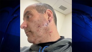 Stoneham, Massachusetts, police Officer Joseph Ponzo after a dog attack left him with 30 stitches.