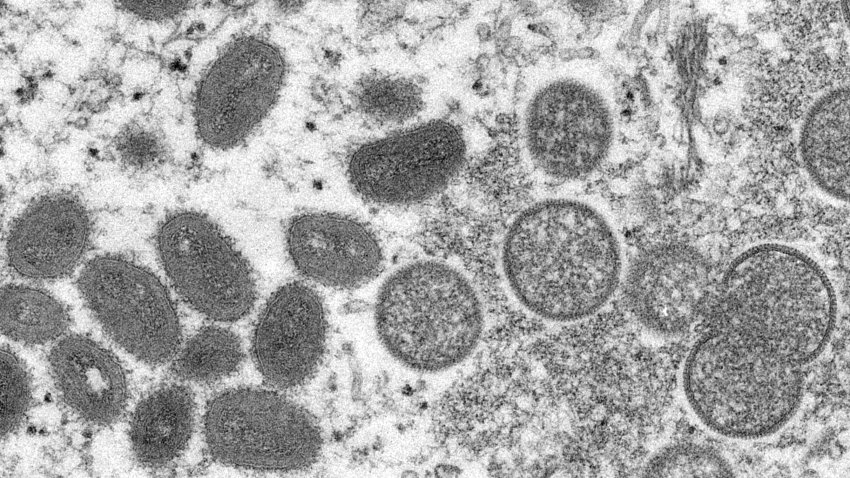 ¿Existe un tratamiento para la viruela del mono? Lo que debes saber