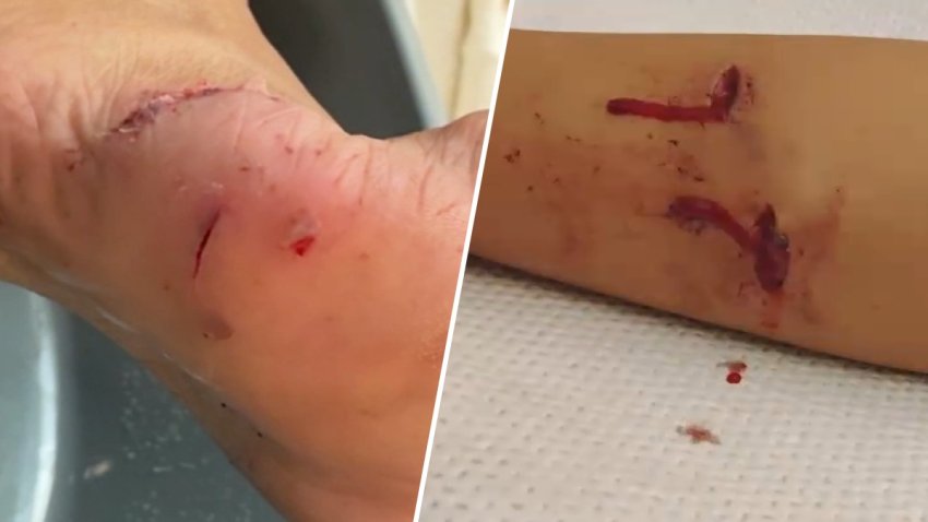 The injuries to Zena Bottom's foot can be seen on the left, with the injuries to Janessa Williams' leg seen on the right.
